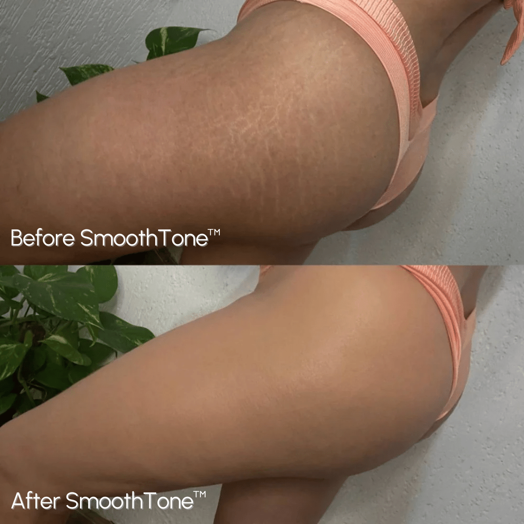 SmoothTone – Full Coverage Body Makeup